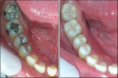 /album/fotogaleria-preguntas-frecuentes/caries-antes-y-despues-png/